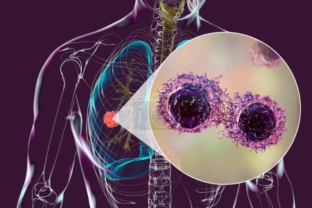 Téléchargez les photos : Un corps humain avec une peau transparente mettant en valeur le cancer du poumon, complété par une vue rapprochée des cellules malignes, illustration 3D. - en image libre de droit