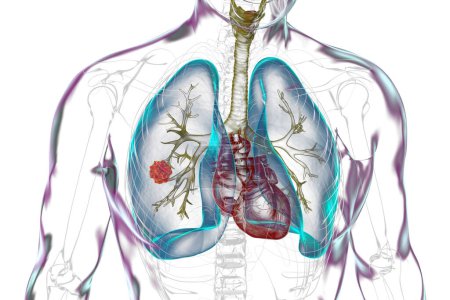 Photo for A human body with transparent skin showcasing lung cancer, 3D illustration. - Royalty Free Image