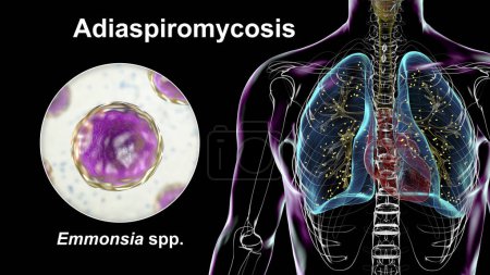 Téléchargez les photos : L'adiaspiromycose pulmonaire, une infection respiratoire rare causée par le champignon Emmonsia spp., caractérisée par la présence de spores fongiques encapsulées élargies dans les tissus pulmonaires, illustration 3D. - en image libre de droit
