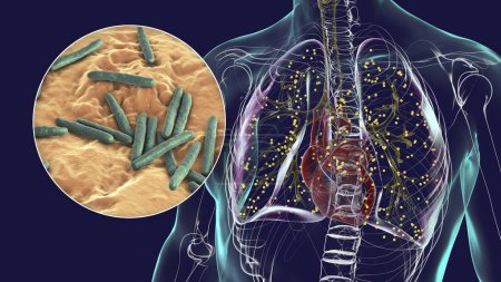 Foto de Una ilustración fotorrealista 3D detallada que muestra los pulmones humanos afectados por la tuberculosis miliar, con una visión cercana de la bacteria Mycobacterium tuberculosis responsable de la infección. - Imagen libre de derechos