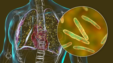 Téléchargez les photos : Une illustration photoréaliste 3D détaillée montrant les poumons humains atteints de tuberculose miliaire, avec une vue rapprochée de la bactérie Mycobacterium tuberculosis responsable de l'infection. - en image libre de droit
