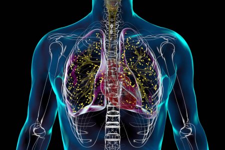 Foto de Una ilustración fotorrealista 3D detallada que muestra los pulmones humanos afectados por la tuberculosis miliar. - Imagen libre de derechos
