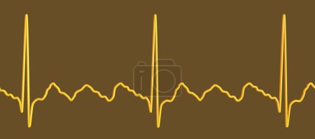 Foto de ECG en aleteo auricular, un ritmo cardíaco anormal caracterizado por contracciones rápidas y regulares de las aurículas. Ilustración 3D que muestra las características ondas P del diente de sierra y el ritmo ventricular irregular. - Imagen libre de derechos