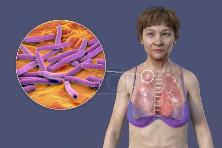 Foto de Una ilustración en 3D que muestra a una paciente con piel transparente, revelando los pulmones afectados por la tuberculosis apical y una visión cercana de la bacteria Mycobacterium tuberculosis. - Imagen libre de derechos