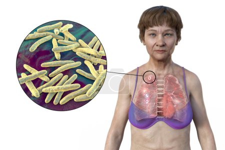 Foto de Una ilustración en 3D que muestra a una paciente con piel transparente, revelando los pulmones afectados por la tuberculosis apical y una visión cercana de la bacteria Mycobacterium tuberculosis. - Imagen libre de derechos