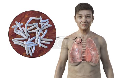 Photo for A 3D illustration showing a female patient with transparent skin, revealing the lungs affected by apical tuberculosis and close-up view of Mycobacterium tuberculosis bacteria. - Royalty Free Image
