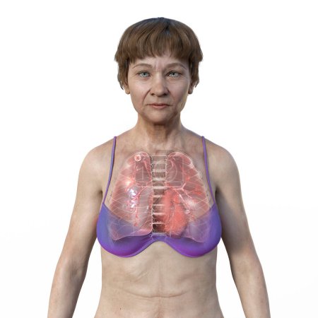 Téléchargez les photos : Illustration 3D montrant une patiente à la peau transparente, révélant les poumons atteints de tuberculose apicale. - en image libre de droit