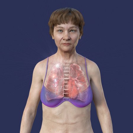 Téléchargez les photos : Illustration 3D montrant une patiente à la peau transparente, révélant les poumons atteints de tuberculose apicale. - en image libre de droit