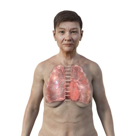 Photo for A 3D illustration showing a female patient with transparent skin, revealing the lungs affected by apical tuberculosis. - Royalty Free Image