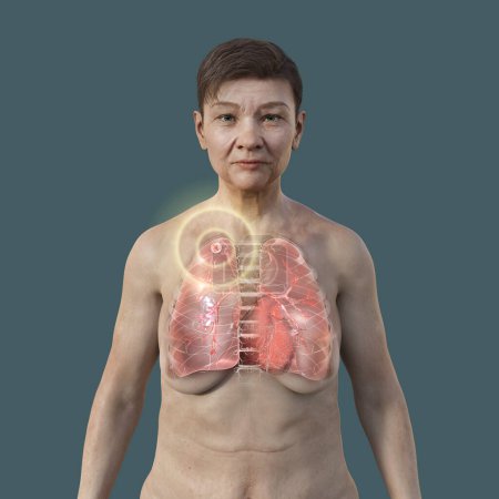 Foto de Una ilustración en 3D que muestra a una paciente con piel transparente, revelando los pulmones afectados por la tuberculosis apical. - Imagen libre de derechos