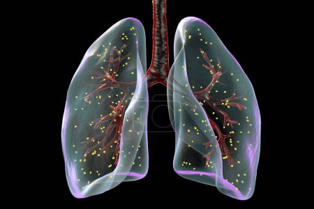 Téléchargez les photos : L'adiaspiromycose pulmonaire, une infection respiratoire rare causée par le champignon Emmonsia spp., caractérisée par la présence de spores fongiques encapsulées élargies dans les tissus pulmonaires, illustration 3D. - en image libre de droit