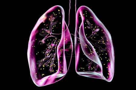 La adiaspiromicosis pulmonar, una rara infección respiratoria causada por el hongo Emmonsia spp., caracterizada por la presencia de esporas fúngicas encapsuladas agrandadas dentro de los tejidos pulmonares, ilustración 3D.