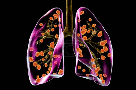 Foto de Histoplasmosis pulmonar, una infección fúngica causada por Histoplasma capsulatum. Ilustración 3D que muestra pequeños nódulos dispersos por los pulmones. - Imagen libre de derechos