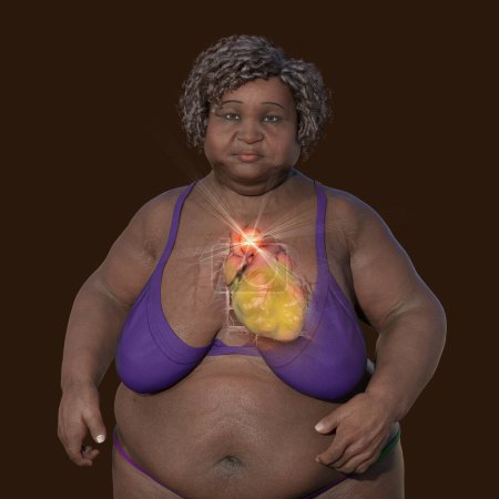 Foto de Ilustración científica en 3D que representa a una mujer obesa con piel transparente, revelando un aneurisma aórtico ascendente, un concepto que destaca la asociación del aneurisma aórtico ascendente con la obesidad. - Imagen libre de derechos