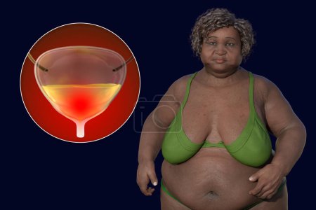 Photo for Scientific 3D illustration of an overweight senior woman with a close-up view of her urinary bladder, conceptualizing urinary problems in obesity, including overactive bladder. - Royalty Free Image