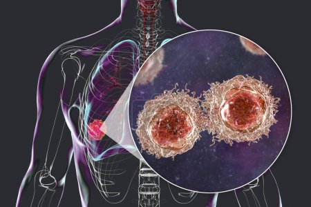 Téléchargez les photos : Un corps humain avec une peau transparente mettant en valeur le cancer du poumon, complété par une vue rapprochée des cellules malignes, illustration 3D. - en image libre de droit