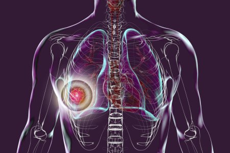 Un cuerpo humano con piel transparente mostrando cáncer de pulmón, ilustración 3D.
