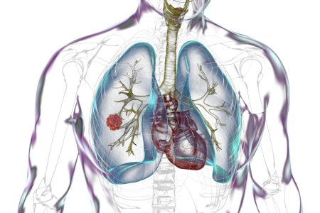 Téléchargez les photos : Un corps humain avec une peau transparente mettant en valeur le cancer du poumon, illustration 3D. - en image libre de droit