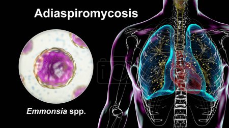 Photo for Lung adiaspiromycosis, a rare respiratory infection caused by the fungus Emmonsia spp., characterized by the presence of enlarged encapsulated fungal spores within lung tissues, 3D illustration. - Royalty Free Image