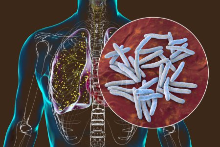 Téléchargez les photos : Une illustration photoréaliste 3D détaillée montrant les poumons humains atteints de tuberculose miliaire, avec une vue rapprochée de la bactérie Mycobacterium tuberculosis responsable de l'infection. - en image libre de droit