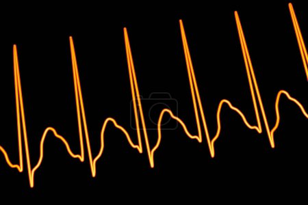 Foto de ECG en aleteo auricular, un ritmo cardíaco anormal caracterizado por contracciones rápidas y regulares de las aurículas. Ilustración 3D que muestra las características ondas P del diente de sierra y el ritmo ventricular irregular. - Imagen libre de derechos