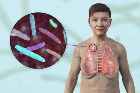 Téléchargez les photos : Illustration 3D montrant une patiente à la peau transparente, révélant les poumons atteints de tuberculose apicale et une vue rapprochée de la bactérie Mycobacterium tuberculosis. - en image libre de droit