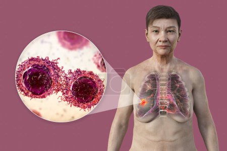 Photo for A 3D photorealistic illustration of the upper half part of a woman with transparent skin, revealing the presence of lung cancer, and close-up view of cancer cells. - Royalty Free Image