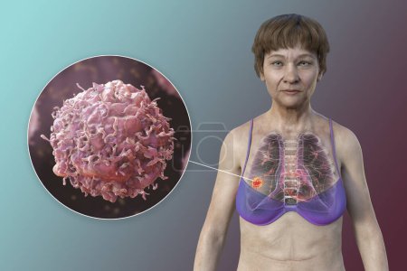 Téléchargez les photos : Illustration photoréaliste 3D de la moitié supérieure d'une femme à la peau transparente, révélant la présence d'un cancer du poumon, et vue rapprochée des cellules cancéreuses. - en image libre de droit