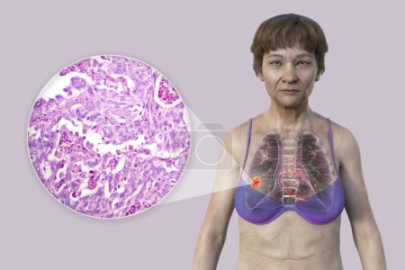 Foto de Una mujer con cáncer de pulmón, ilustración 3D, junto con una imagen micrográfica del tejido de cáncer de pulmón. - Imagen libre de derechos