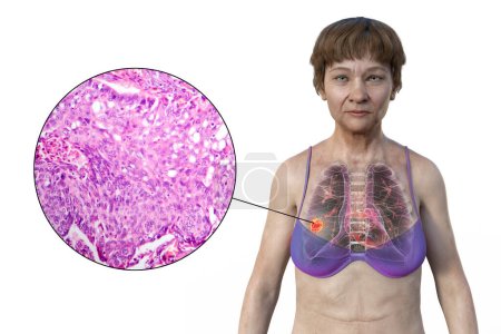 Téléchargez les photos : Une femme atteinte d'un cancer du poumon, illustration 3D, avec une image micrographique du tissu du cancer du poumon. - en image libre de droit