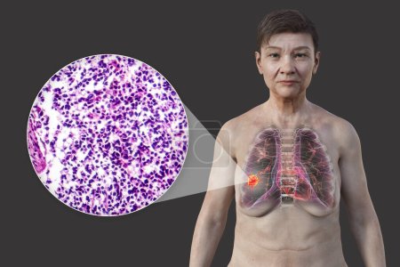 Foto de Una mujer con cáncer de pulmón, ilustración 3D, junto con una imagen micrográfica de cáncer de pulmón de células pequeñas. - Imagen libre de derechos