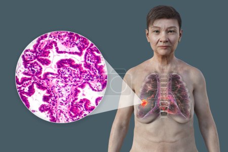 Foto de Una mujer con cáncer de pulmón, ilustración 3D, junto con una imagen micrográfica de adenocarcinoma de pulmón. - Imagen libre de derechos