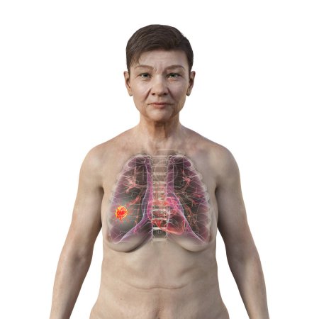 Téléchargez les photos : Illustration photoréaliste 3D de la moitié supérieure d'une femme à la peau transparente, révélant la présence d'un cancer du poumon. - en image libre de droit