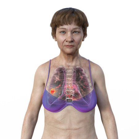 Foto de Una ilustración fotorrealista en 3D de la mitad superior de una mujer con piel transparente, revelando la presencia de cáncer de pulmón. - Imagen libre de derechos