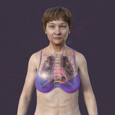 Photo for A 3D photorealistic illustration of the upper half part of a woman with transparent skin, revealing the presence of lung cancer. - Royalty Free Image