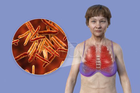 Photo for A 3D illustration showing a female patient with transparent skin, revealing the lungs affected by miliary tuberculosis and close-up view of Mycobacterium tuberculosis bacteria. - Royalty Free Image