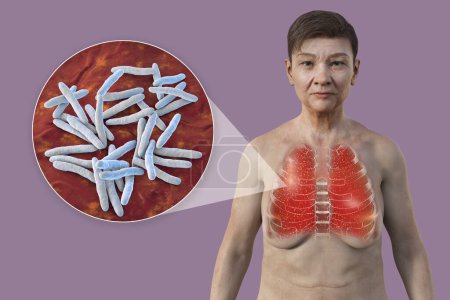 Foto de Una ilustración en 3D que muestra a una paciente con piel transparente, revelando los pulmones afectados por la tuberculosis miliar y una visión cercana de la bacteria Mycobacterium tuberculosis. - Imagen libre de derechos
