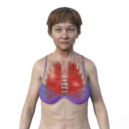 Foto de Una ilustración en 3D que muestra a una paciente con piel transparente, revelando los pulmones afectados por la tuberculosis miliar. - Imagen libre de derechos