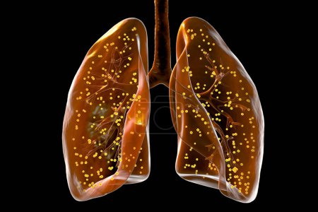 Photo for A detailed 3D photorealistic illustration showcasing human lungs affected by miliary tuberculosis. - Royalty Free Image