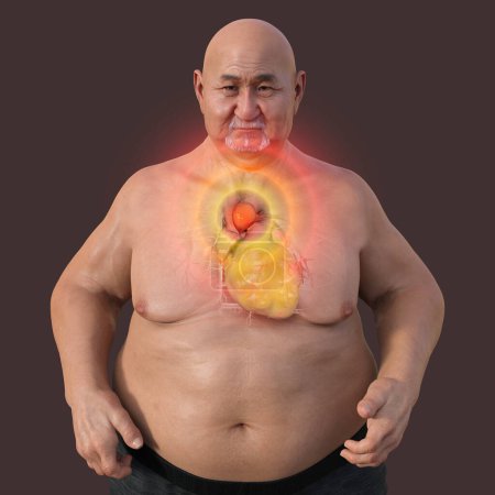Photo for 3D scientific illustration depicting an obese man with transparent skin, revealing an ascending aortic aneurysm, a concept highlighting the association of ascending aortic aneurysm with obesity. - Royalty Free Image