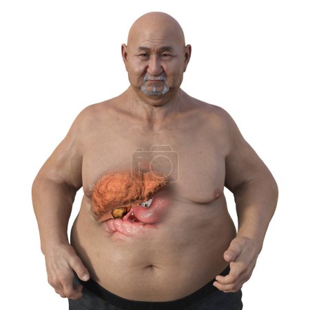 Foto de Una ilustración médica en 3D con un hombre con sobrepeso y piel transparente, mostrando el hígado y destacando la presencia de esteatosis hepática. - Imagen libre de derechos