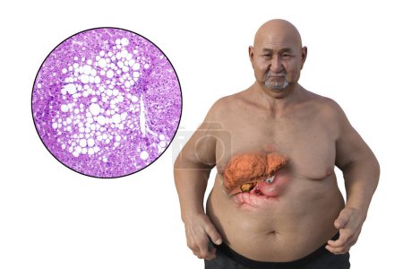 Foto de Una ilustración médica en 3D con un hombre con sobrepeso y piel transparente, mostrando el hígado y destacando la presencia de esteatosis hepática, junto con una imagen micrográfica de esteatosis hepática. - Imagen libre de derechos