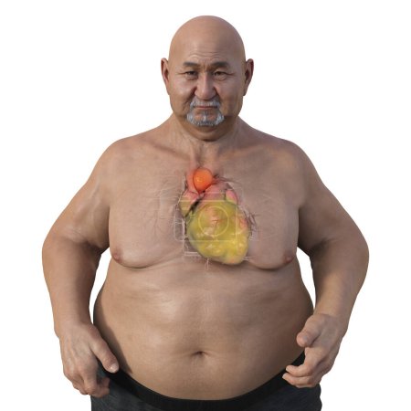Foto de Ilustración científica en 3D que representa a un hombre obeso con piel transparente, revelando un aneurisma aórtico ascendente, un concepto que destaca la asociación del aneurisma aórtico ascendente con la obesidad. - Imagen libre de derechos