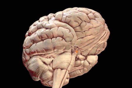Tumor de la glándula pituitaria, ilustración médica en 3D que destaca su ubicación e impacto en las estructuras cercanas.