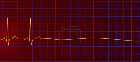 Foto de Asístole, una condición crítica marcada por la ausencia de actividad eléctrica cardiaca. La ilustración 3D muestra una línea plana en el ECG, lo que significa un corazón que no funciona sin pulso o latido del corazón. - Imagen libre de derechos