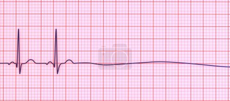 Photo for Asystole, a critical condition marked by the absence of any cardiac electrical activity. 3D illustration shows a flatline on the ECG, signifying a nonfunctioning heart with no pulse or heartbeat. - Royalty Free Image