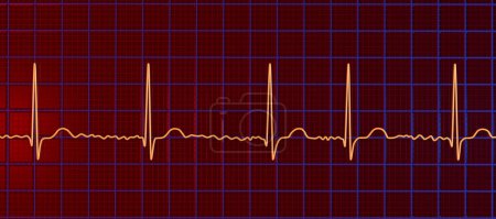 ECG in atrial fibrillation (AFib), a 3D illustration depicts irregular rhythm, absent P waves, and rapid, chaotic atrial activity, posing a risk of palpitations and stroke.