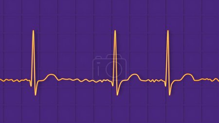 Téléchargez les photos : ECG en fibrillation auriculaire (AFib), une illustration 3D représente un rythme irrégulier, des ondes P absentes et une activité auriculaire rapide et chaotique, présentant un risque de palpitations et d'AVC. - en image libre de droit