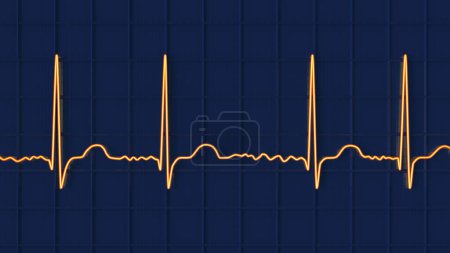 Photo for ECG in atrial fibrillation (AFib), a 3D illustration depicts irregular rhythm, absent P waves, and rapid, chaotic atrial activity, posing a risk of palpitations and stroke. - Royalty Free Image