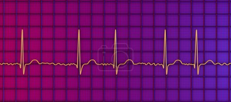 Téléchargez les photos : ECG en fibrillation auriculaire (AFib), une illustration 3D représente un rythme irrégulier, des ondes P absentes et une activité auriculaire rapide et chaotique, présentant un risque de palpitations et d'AVC. - en image libre de droit